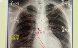 胸片拍片有哪些关键技巧？