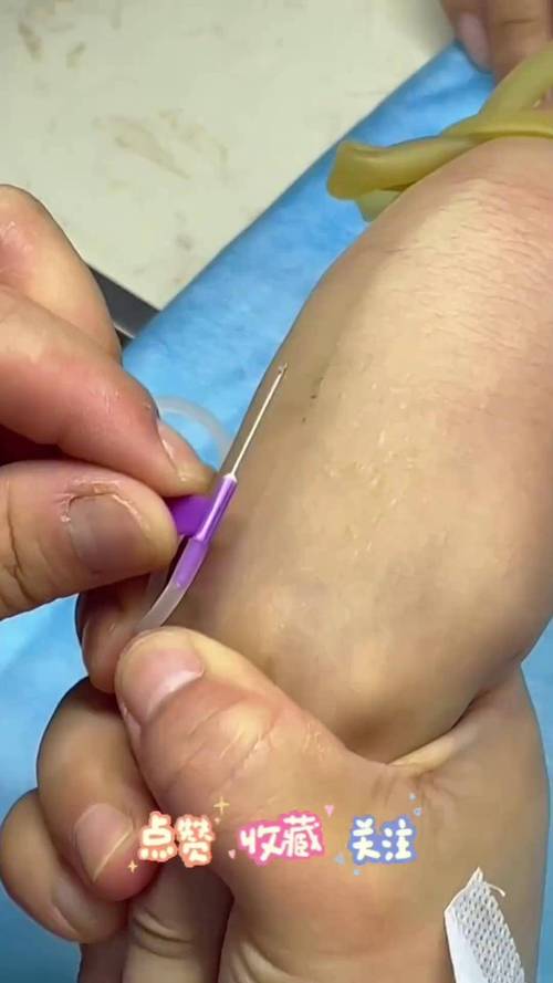 新手护士扎针技巧视频如何快速掌握？-图3