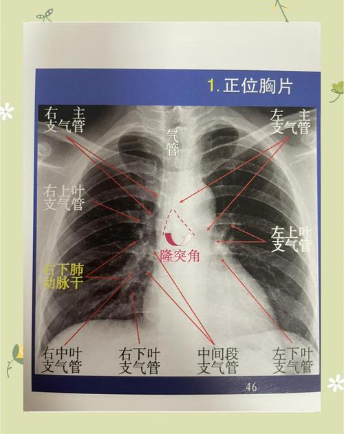 胸片拍片有哪些关键技巧？-图1