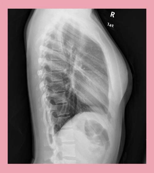 胸片拍片有哪些关键技巧？-图3